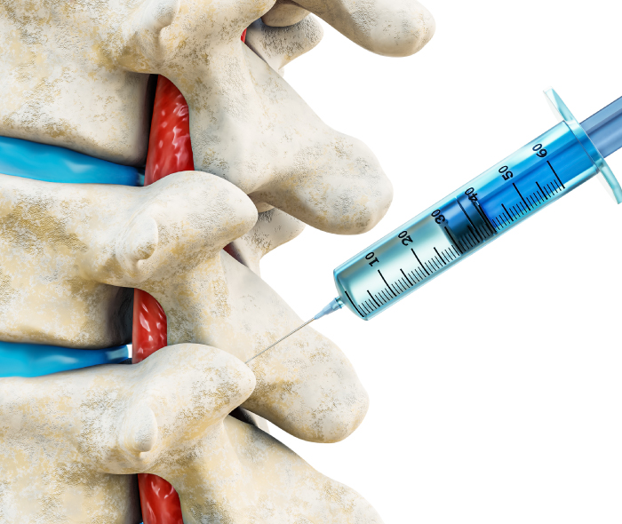 Steroid Injections for Back Pain