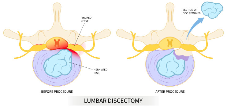 discectomy