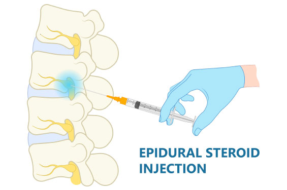 epidural_steroid_injection