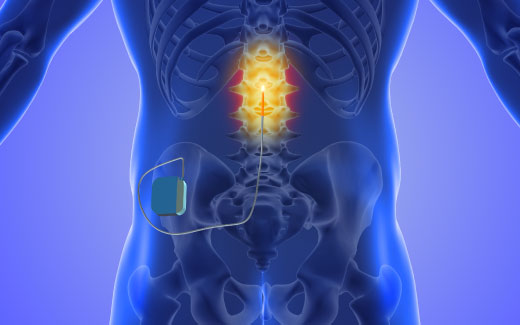 spinal_cord_stimulation