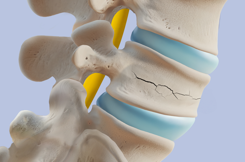 compression_fracture_treatment_NSC
