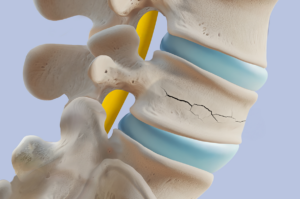 compression_fracture_treatment_NSC