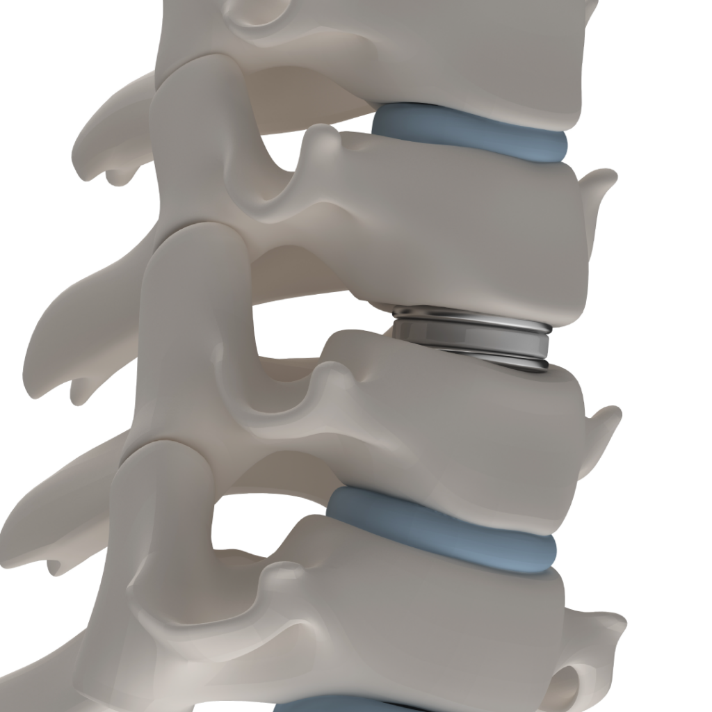 disc_replacement_treatment